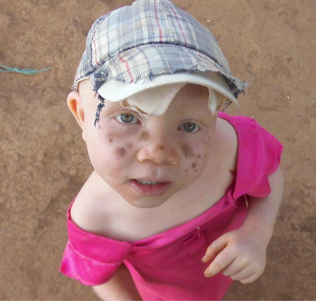 A Tanzanian Toddler already showing signs of severe skin damage from the sun